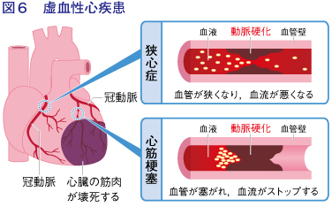 図6:虚血性心疾患