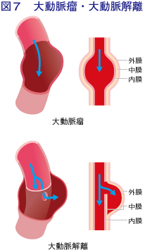 図7:大動脈瘤・大動脈解離